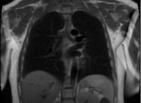 Genetic Association on Human skeleton features obtained from MRI scans
